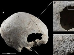Perempuan dari 4.500 Tahun Lalu Ini Selamat dari Operasi Tengkorak, tapi...
