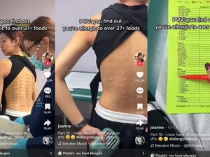 Viral Cerita Wanita yang Alergi 37 Makanan, Mengaku Tersiksa karena Ini Viral Cerita Wanita yang Alergi 37 Makanan, Mengaku Tersiksa karena Ini
