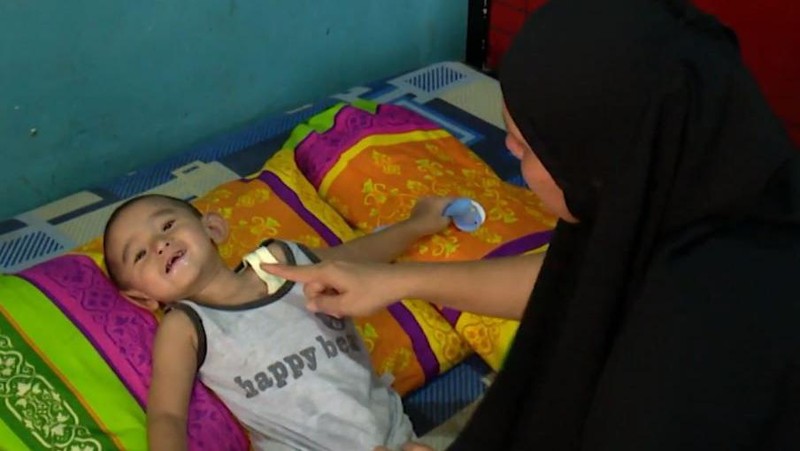 Kisah Pilu Balita Amar Didera Kelainan Jantung, Usus hingga Lambung