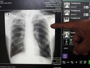 TBC di Indonesia Tembus 1 Juta Kasus, Warga Diminta Tak Takut Berobat TBC di Indonesia Tembus 1 Juta Kasus, Warga Diminta Tak Takut Berobat