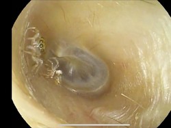 Bikin Merinding, Viral Laba-laba Hidup dan Ganti Kulit di Telinga Wanita Ini