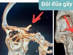 Pria Ini Sakit Kepala Selama Lima Bulan Ternyata Ada Sumpit di Kepalanya