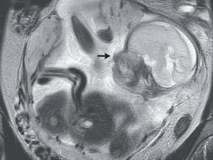 Wanita Ini Ngeluh Sakit Perut-Kembung 10 Hari, Ternyata Ada Bayi di Dekat Ususnya