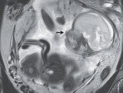 Wanita Ini Ngeluh Sakit Perut-Kembung 10 Hari, Ternyata Ada Bayi di Dekat Ususnya