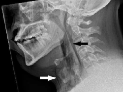 Ngilu Banget! Tenggorokan Pria Umur 30-an Terkoyak Akibat Menahan Bersin