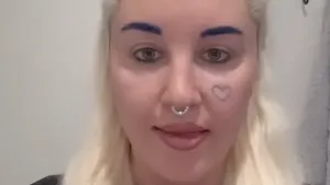 Foto Baru Amanda Bynes Setelah Operasi Lipatan Mata, Hampir Tak Dikenali