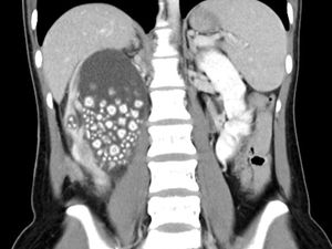 Gejala Awal Timbulnya Batu Ginjal, Waspadalah!