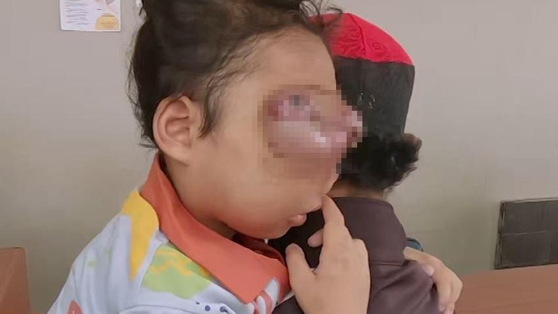 Malangnya Assyfa, Anak Tukang Kebun yang Mengidap Tumor hingga Kanker