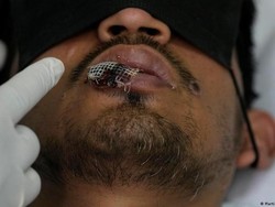 WHO Ingatkan Wabah Mpox Berpotensi Menyebar Kembali ke Seluruh Dunia