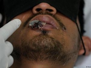 Ini Kelompok dan Usia yang Banyak Terpapar Mpox Ini Kelompok dan Usia yang Banyak Terpapar Mpox