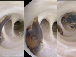 Awal Mula Cacing Parasit Bersarang di Tubuh Pasien Kanker Pasca Makan Ini