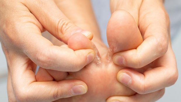 Closeup of barefoot of girl suffering with athlete's foot due to a fungal infection