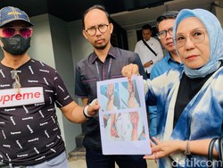 Tangan Petrus Cacat Diduga Korban Malapraktik Pasang Infus di Palembang