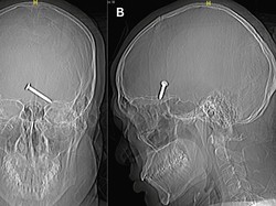 Ngeri-ngeri Sedap, Pria Lolos dari Maut usai Paku Menembus Mata dan Otak