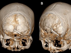 Ngerinya Efek Usai Paku Menembus Otak