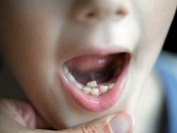 Gigi Nggak Rapi Bisa Bikin Mental Berantakan, Ini Pemicunya Menurut Dokter