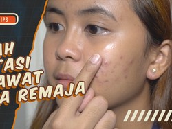 KuTips: 3 Saran Dokter Kulit untuk Obati Jerawat pada Remaja