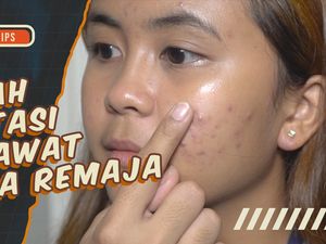 KuTips: 3 Saran Dokter Kulit untuk Obati Jerawat pada Remaja KuTips: 3 Saran Dokter Kulit untuk Obati Jerawat pada Remaja