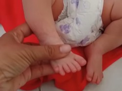 Begini Kondisi Bayi di Sampang yang Lahir dengan 24 Jari