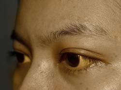 Asal Konsumsi Obat Herbal, Tubuh Wanita Ini Menguning Seperti Karakter Simpson