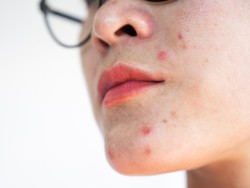 Muncul Jerawat di Atas Bibir? Ini Penyebab dan Cara Mengatasinya