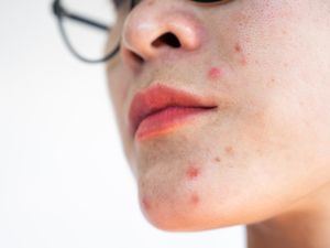 Muncul Jerawat di Atas Bibir? Ini Penyebab dan Cara Mengatasinya Muncul Jerawat di Atas Bibir? Ini Penyebab dan Cara Mengatasinya