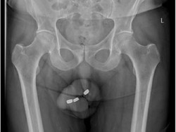 Waduh Pria Lansia Ini Masukkan Baterai ke Penis, Kok Bisa?