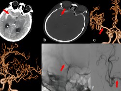 Penampakan Jarum Akupunktur Nyangkut di Otak, Diduga Sudah Ada Selama 20 Tahun