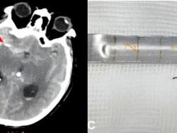 Ngeri, Dokter Temukan Jarum Akupunktur yang Tertancap di Otak Pria 74 Tahun