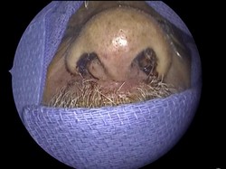 Penampakan Ratusan Serangga Hidup Dalam Hidung, Ada yang Hampir Masuk Otak