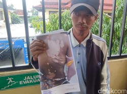 IRT di Palembang Disiram Suami Pakai Air Panas, Keluarga Laporkan KDRT