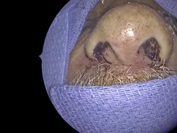 Viral 150 Larva Hidup di Hidung Orang Ini, Masih Uget-uget