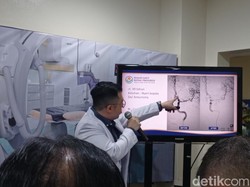 Mengenal Digital Subtraction Angiography, Fungsinya dalam Penanganan Stroke