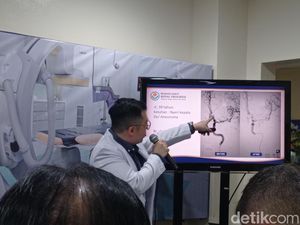 Dokter Spesialis Saraf: 90% Stroke Bisa Dicegah Dokter Spesialis Saraf: 90% Stroke Bisa Dicegah