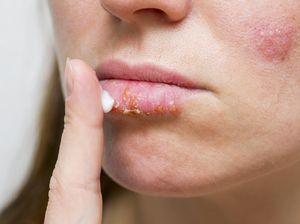 5 Nama Penyakit yang Pakai Nama Makanan, Ruam Blueberry dan Perut Semangka