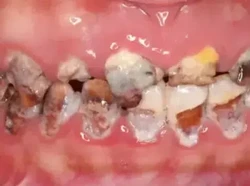 Gigi Wanita Ini Membusuk gegara Kebanyakan Minum Soda