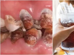 Minum Soda Tiap Hari, Wanita Ini Keluarkan Rp 442 Juta Untuk Obati Giginya