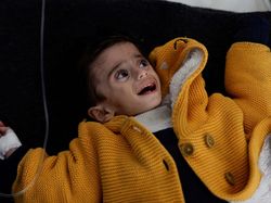 Pilu, Nasib Tragis Bocah Alami Gizi Buruk Akibat Bencana Kelaparan di Gaza