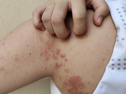 Kemenkes Ingatkan Gejala Awal Kusta yang Kerap Diabaikan, Ini Ciri-cirinya di Kulit