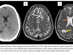Pria Ini Sampai Migrain 4 Bulan karenanya, Bagaimana Cacing Pita Masuk ke Otak?
