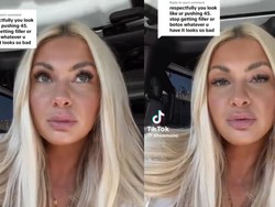 Nestapa Wanita 22 Tahun Berwajah Lebih Tua gegara Keseringan Botox dan Filler