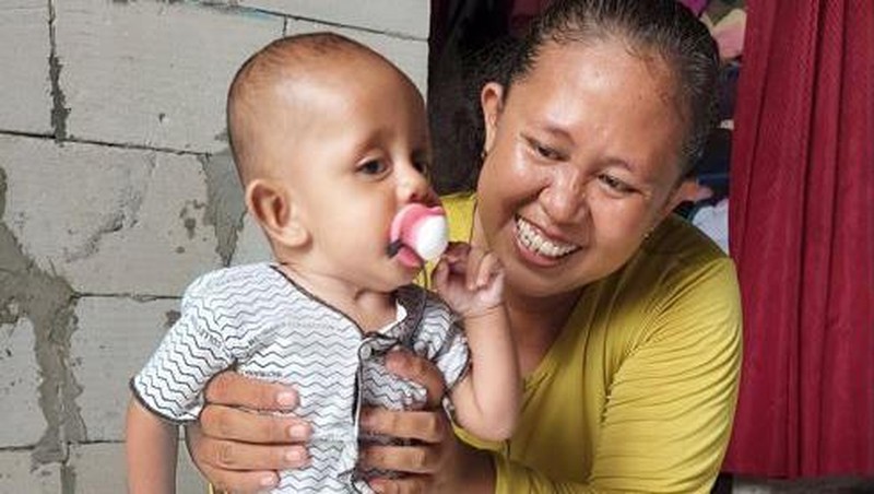 Pilunya Rey, Anak Tukang Somay yang Derita Stunting dan Kelainan Tubuh