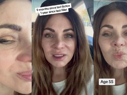 Sempat Viral Efek Wanita Setop Botox Setelah 20 Tahun, Begini Nasibnya Sekarang
