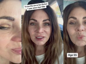 Sempat Viral Efek Wanita Setop Botox Setelah 20 Tahun, Begini Nasibnya Sekarang Sempat Viral Efek Wanita Setop Botox Setelah 20 Tahun, Begini Nasibnya Sekarang