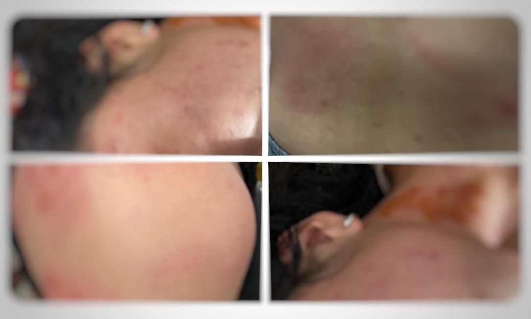 Luka di Tubuh RST