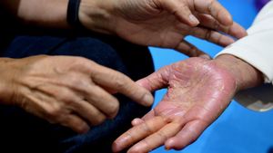 Edukasi Psoriasis untuk Para Penderita di Bali