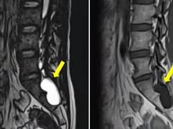 Alami Ejakulasi Dini Selama 2 Tahun, Tak Tahunya Ada Kista di Tulang Belakang