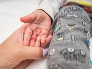 Rentan Menyerang Anak, Apakah Flu Singapura Menular atau Tidak? Rentan Menyerang Anak, Apakah Flu Singapura Menular atau Tidak?