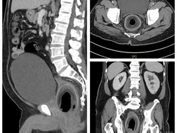 Aneh tapi Nyata, Dokter Temukan Kelapa di Dalam Rektum Pria Taiwan