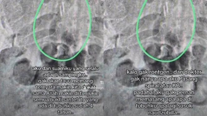 Instagram stories foto hasil rontgen tubuh Stevie Agnecya